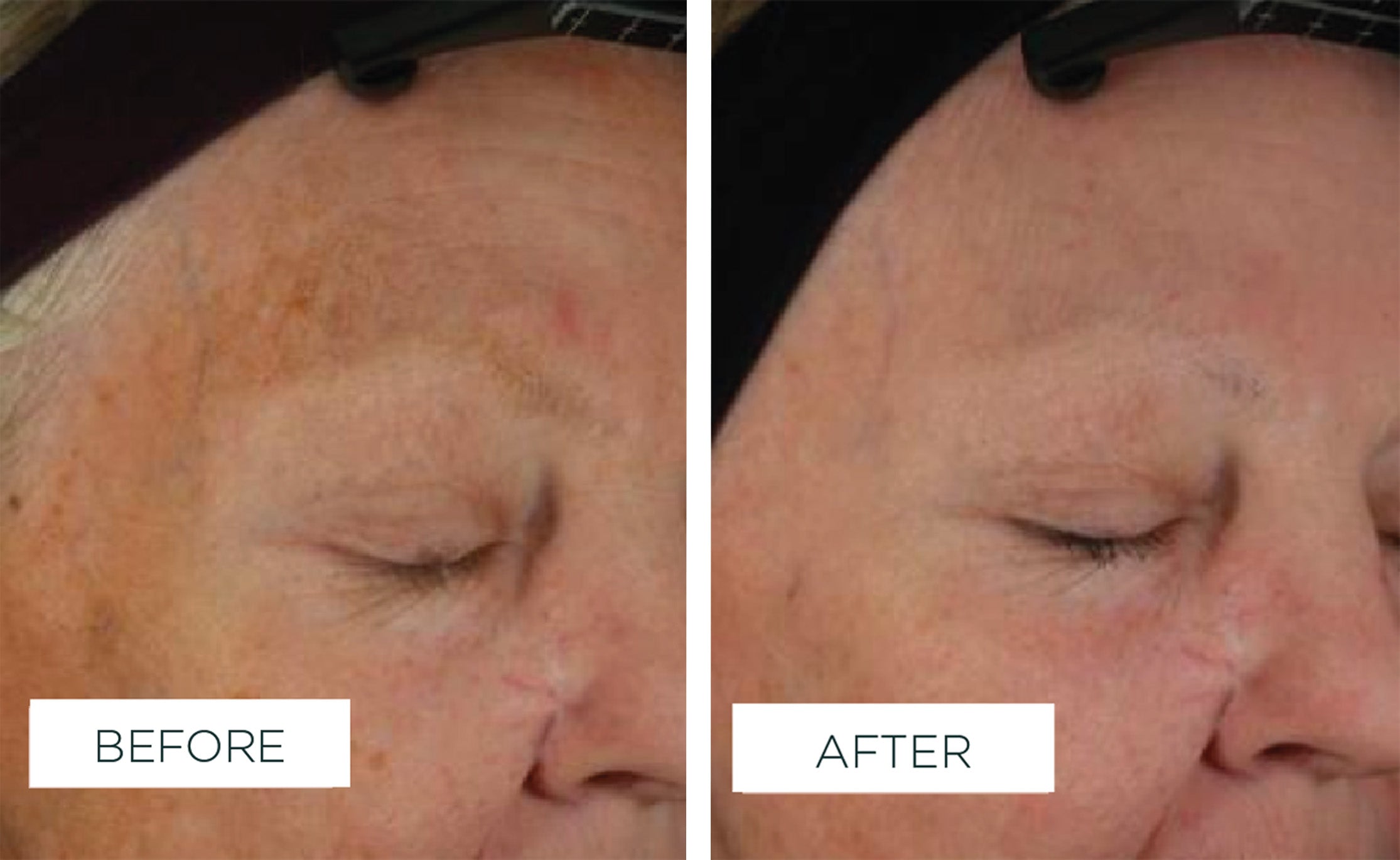 Veriphy'd by science | Clinical results | Before & After image