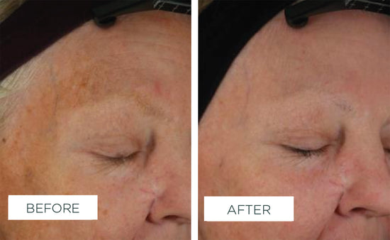 Veriphy'd by science | Clinical results | Before & After image